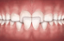 cross bite teeth