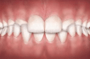 crossbite backteeth