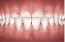 underbite teeth