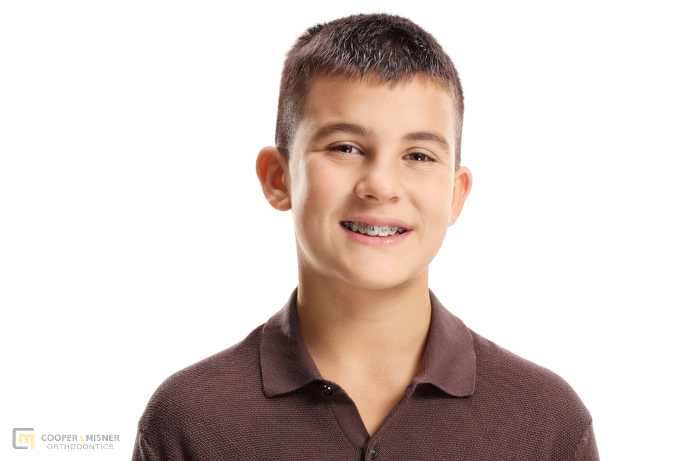 Braces for Overbite in Tulsa, Braces for Overbite in Tulsa, OK, Cooper &amp; Misner Orthodontics