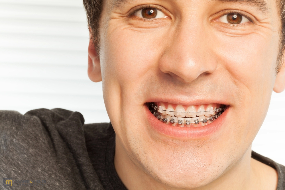 happy young man with metal braces - Overbite vs Underbite in Tulsa, OK
